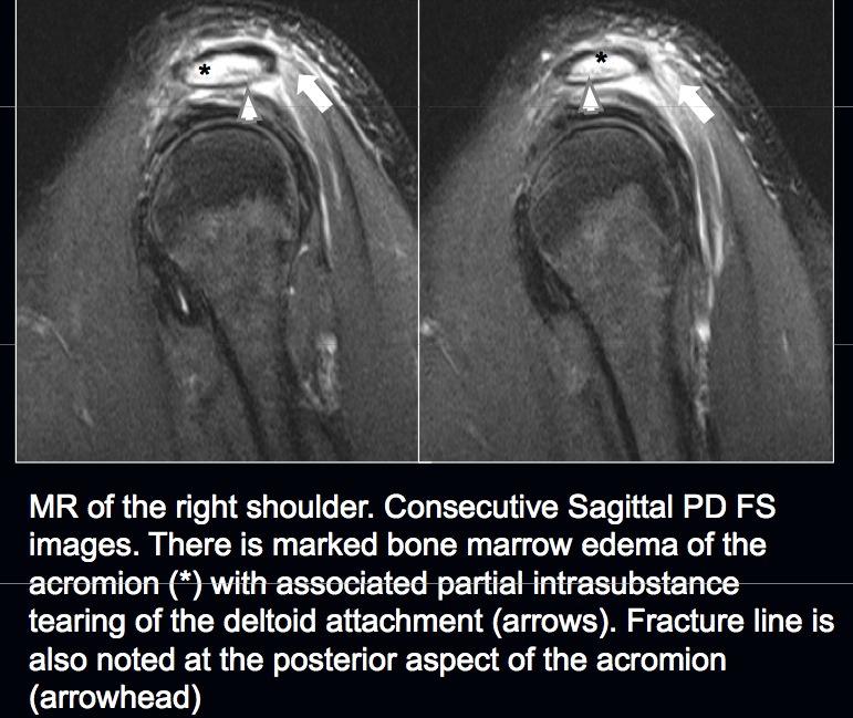 Figure 3 for case Partial deltoid tendon tear